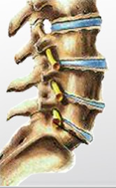 degenerative disc disease