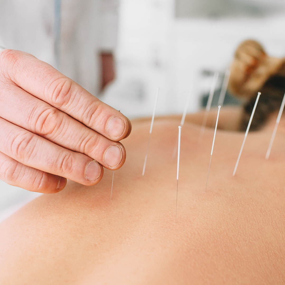 can-acupuncture-help-with-anxiety