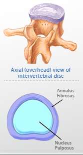 herniated disc 1
