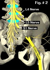 sciatica