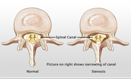 https://www.drpicard.com/img/spinal-stenosis.jpg
